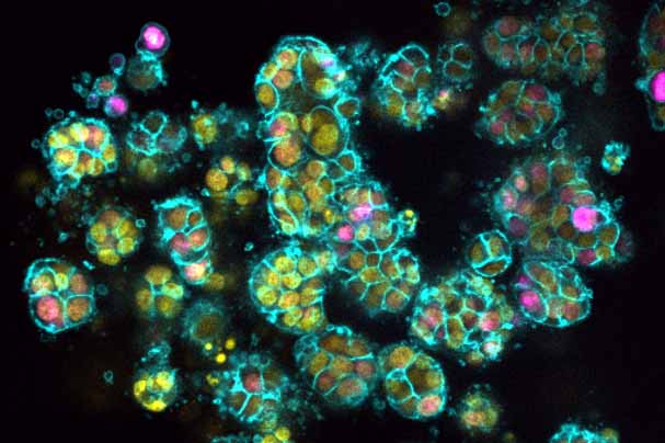 Pictured are 3D structures formed by human pancreatic cancer cells, known as organoids.